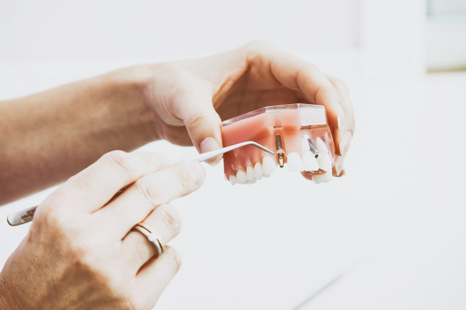 Dental Crowns